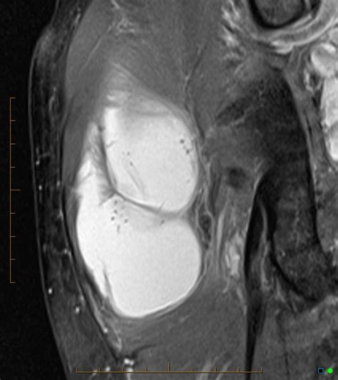 Ruptured Sub Gluteus Maximus Trochanteric Bursa Image