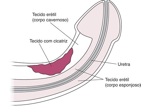 Disfunção erétil (DE) - Disfunção erétil (DE) - Manual MSD Versão Saúde
