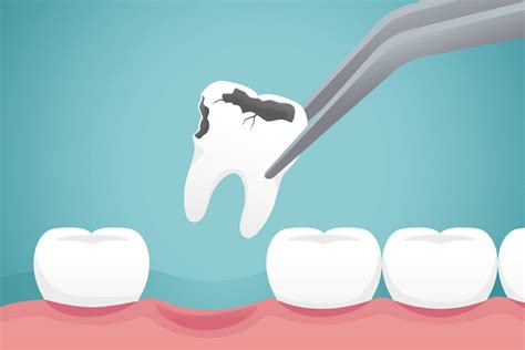 The Dangers Of Not Replacing Missing Teeth Dr Gallardo