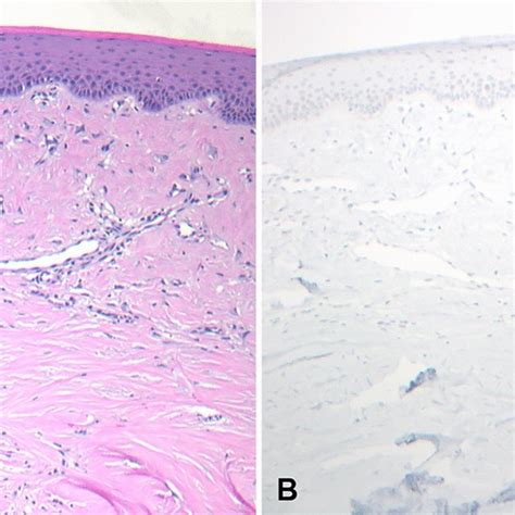 Photomicrographs showing a giant cell fibroma. A A giant cell fibroma... | Download Scientific ...