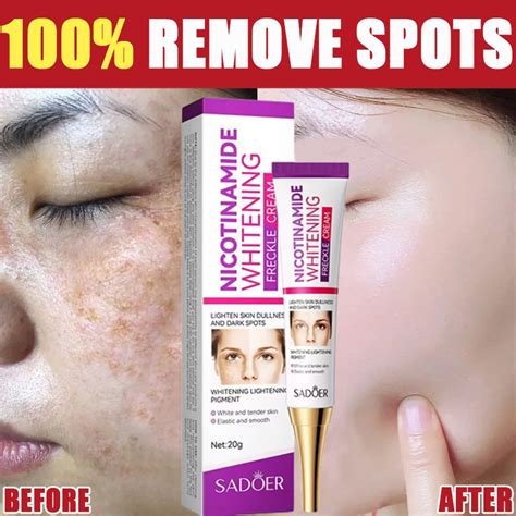 Melasma Cream Niacinamide Whitening Freckle Cream Pekas Remover