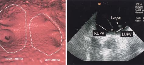 Ct And Intracardiac Echocardiographic Depiction Of The Pv Antrum Left