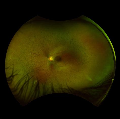 The Retina Clinic Retinitis Pigmentosa RP