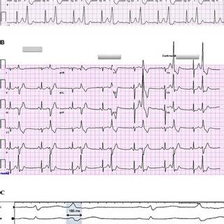 A Lead Electrocardiogram Showing Premature Ventricular Complex With