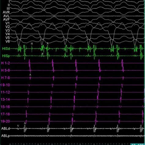 Twelve Lead Surface Electrocardiogram And Intra Cardiac Recordings