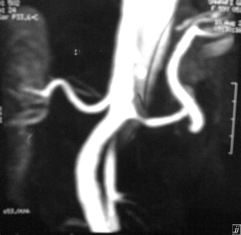 Abdomen Renal Artery Origin Stenosis With Aortic Dissection Mra