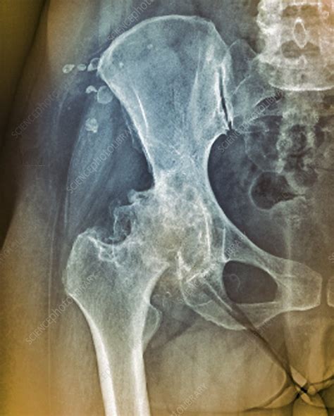 Osteoarthritis Of The Hip X Ray Stock Image C040 3325 Science Photo Library