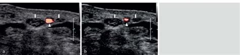 A B Transverse Power Doppler HRUS Scan Of The Wrist Depicting A Bifid