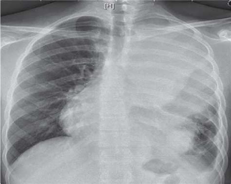 Chest Radiograph Postero Anterior View Showing Homogeneous Opacity In