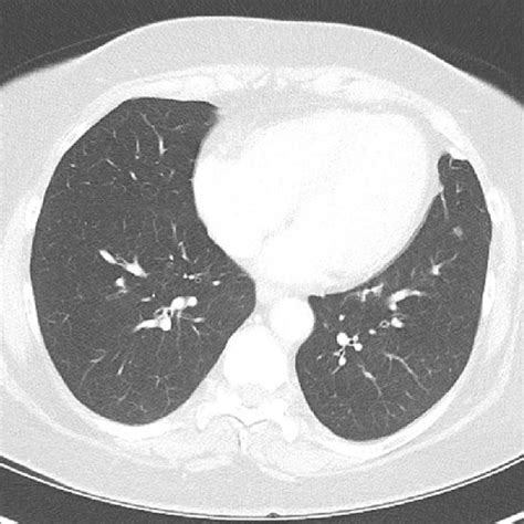 Axial Ct Image Shows A 5 Mm Partially Solid Nodule In The Left Lower Download Scientific