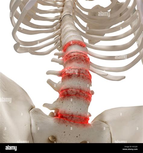 Arthritis in the lumbar spine, illustration Stock Photo - Alamy