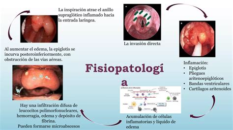 Laringitis Crup Viral Epiglotitis Pptx