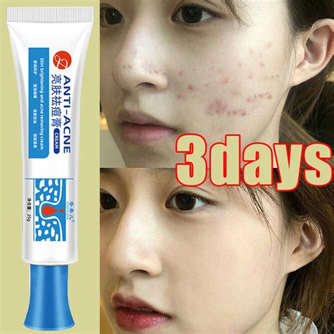 Remove Pimples Quickly Cream Fades Acne Marks Repairs Acne Pits Facial