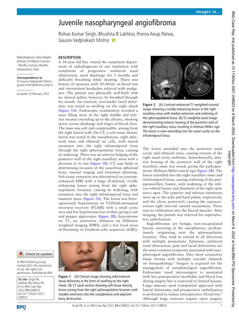 (PDF) Juvenile nasopharyngeal angiofibroma