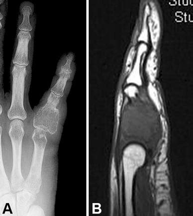 A Radiograph And B Sagittal Mri Of The Hand Of A Year Old Woman With