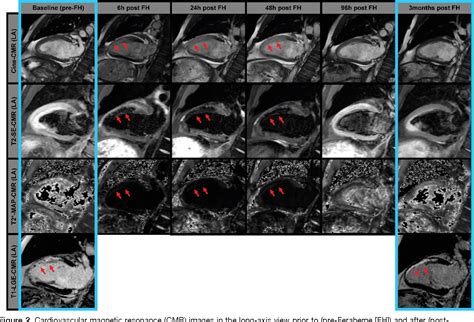 Figure 2 From First Multiparametric Cardiovascular Magnetic Resonance