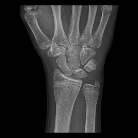 Teenager with wrist pain after a fall | Pediatric Radiology Case