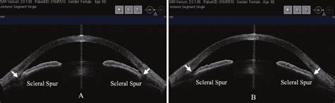 A Anterior Segment Optical Coherence Tomography ASOCT Imaging Shows