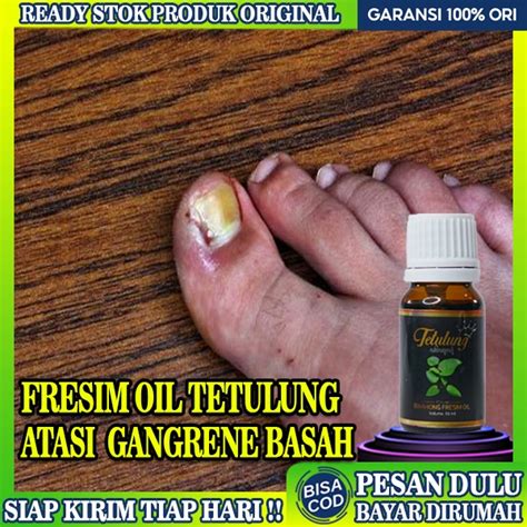 Jual Obat Cantengan Kuku Jempol Kaki Fresim Oil Obat Gangrene Basah