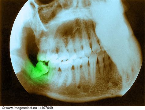 Impacted Wisdom Tooth Impacted Wisdom Tooth,colorised,colorization,x ...