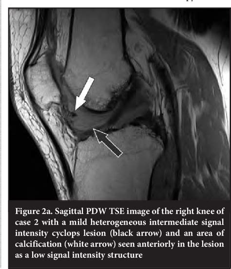 Pdf Mri Findings Of Cyclops Lesions Of The Knee Semantic Scholar