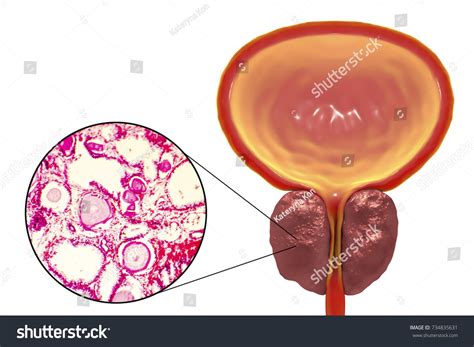 Hypertrophie B Nigne De La Prostate Illustrations Images Et