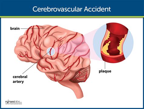 Cerebrovascular Accident Stroke Nursing Care And Management A Study