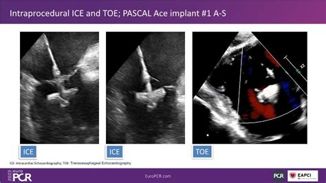 Tailoring Tricuspid Regurgitation Patient Treatment With The Pascal