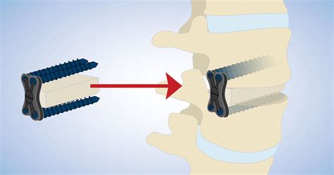 Direct Lateral Interbody Fusion Dlif Atlanta Ga Spine Surgery