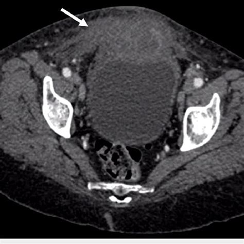 Axial Ct Image Axial Ct Image Of The Pelvis Showing A Soft Tissue Mass Download Scientific