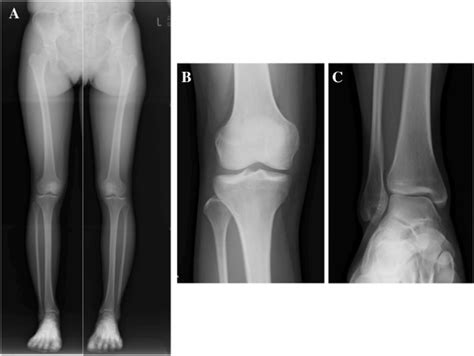 Plain Radiographic Findings Of The Full Length Of The Lower Limbs Knee