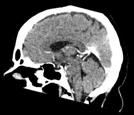 Azygos Anterior Cerebral Artery Image Radiopaedia Org