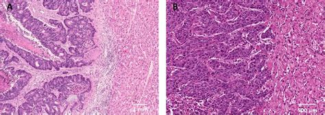 Frontiers Histopathological Growth Pattern Of Liver Metastases As An Independent Marker Of