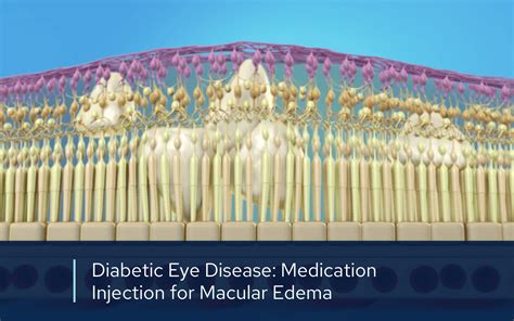 Avastin, Eylea & Lucentis Injections | Retinal Consultants Medical Group