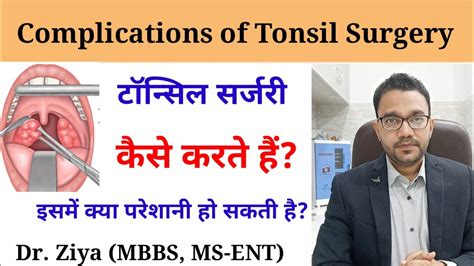 Tonsil Surgery Me Risk टॉन्सिल के ऑपरेशन में खतरे Tonsil Surgery