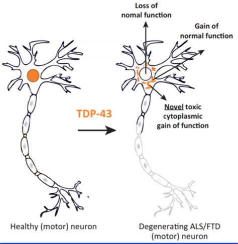 Motor neuron disease Flashcards | Quizlet