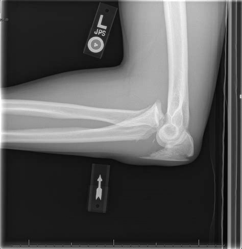 Elbow Dislocation Radiology Case Radshare Net