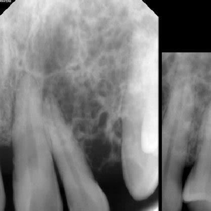 Periapical Radiographs Show A Large Cystic Lesion On The Apical Region