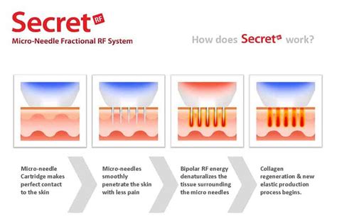 Microneedling Radiofrequency Rf Treatments Dermetics