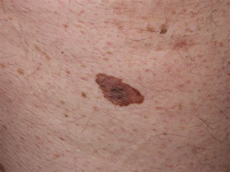 Immagini Melanoma E Tumori Della Pelle In Diversi Stadi