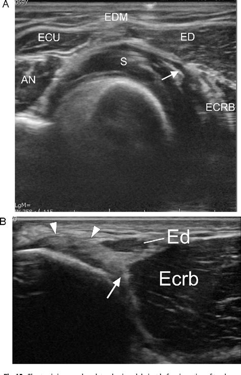 Figure 15 From Ultrasound Of The Elbow With Emphasis On Detailed