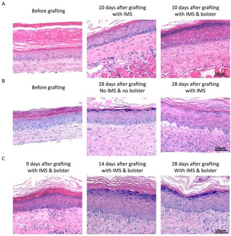 IJMS Free Full Text Tie Over Bolster Pressure Dressing Improves