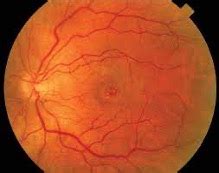 macular hole vitreoretinal surgery foundation