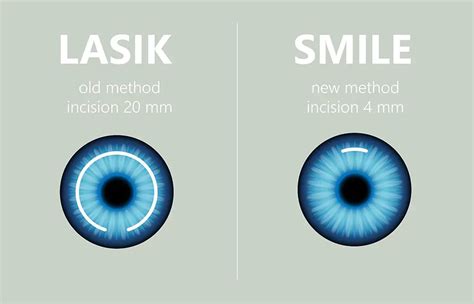 How Long Does SMILE Eye Surgery Last A Comprehensive Look At The