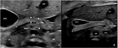 Full Article High Frequency Ultrasound Imaging To Assess Fetal Pancreas A Promising Application