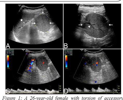 Figure 1 From A Rare Case Of Accessory Spleen Torsion Diagnosed By