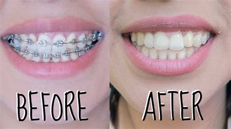 Invisalign Perth Clear Aligners Treatment Cost In Perth