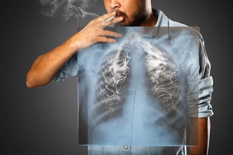 emphysema facts        pulmonary disease