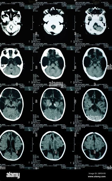 Tomografía computarizada de craneo fotografías e imágenes de alta