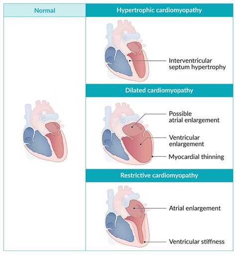 Dilated Cardiomyopathy And Chronic Cardiac Inflammation 41 Off